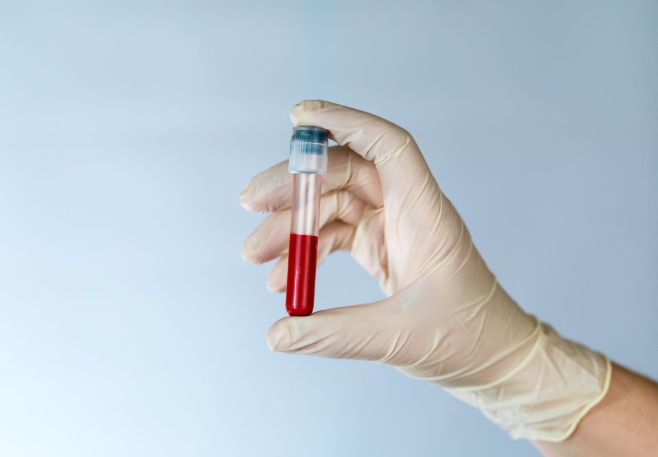 Beta HCG